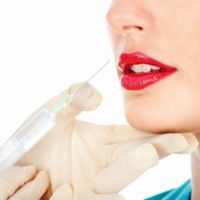 Filler per labbra: tutto quello che devi sapere per scegliere quello giusto