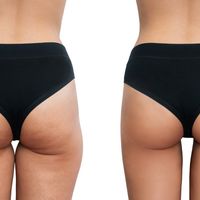 Vuoi Eliminare la Cellulite? Scopri Avéli, il Nuovo Trattamento in Arrivo dagli USA