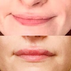 Filler labbra - Dott. Diego Dedola