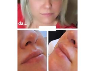 Filler labbra  - Dott. Diego Dedola