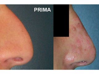 Rinoplastica prima e dopo