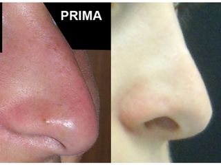 Rinoplastica prima e dopo