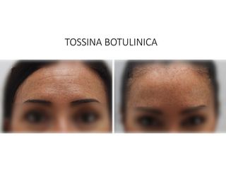 Botulino prima e dopo