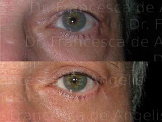 Blefaroplastica prima e dopo