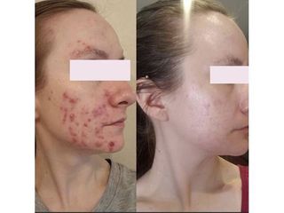 Acne - Dott. Roberto Lualdi