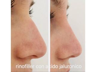 Rinofiller - Dott. Roberto Lualdi