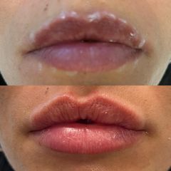filler labbra - Dott. Roberto Lualdi