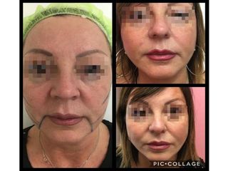 Filler prima e dopo