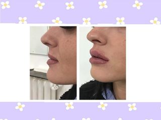Filler labbra prima e dopo
