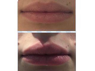 Filler labbra prima e dopo