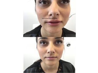 Filler labbra prima e dopo