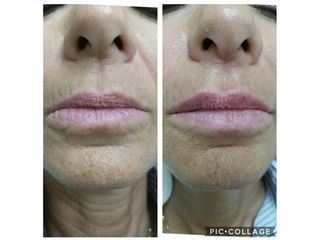 Filler labbra prima e dopo