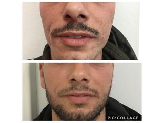 Filler labbra prima e dopo