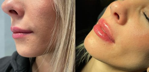 Filler labbra - Dott. Massimiliano Giuliano