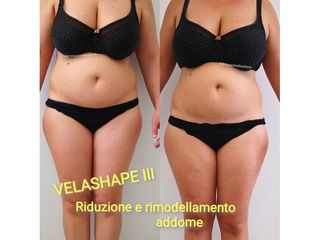 Velashape prima e dopo