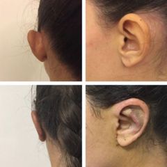 Otoplastica - Dr. Lapalorcia, Studio Di Chirurgia Plastica