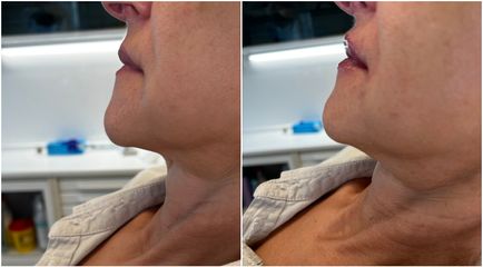 Filler labbra  - Studio Medico Brenno Franceschini