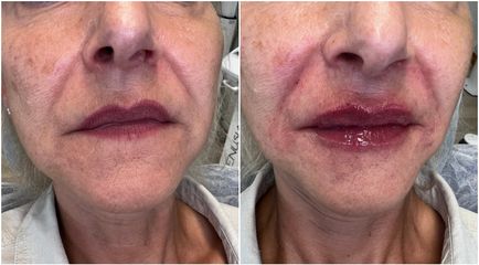 Filler labbra  - Studio Medico Brenno Franceschini