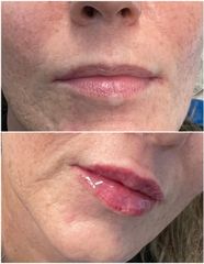 Filler labbra  - Studio Medico Brenno Franceschini
