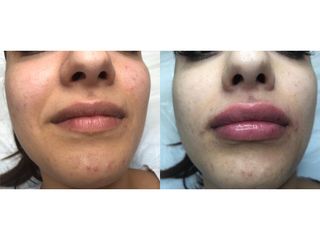 Filler labbra prima e dopo