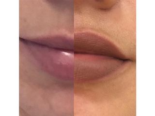 Filler labbra prima e dopo