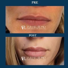 Filler labbra  - Dott.Antonio Russo