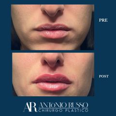Filler labbra - Dott.Antonio Russo