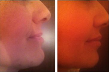 Aumento delle labbra con filler