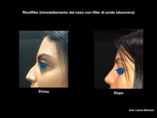 Rinofiller prima e dopo