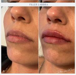 Filler labbra  - Dott.ssa Leticia Molinaro Medicina Plastica