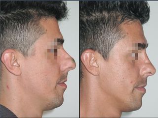 Rinoplastica prima e dopo