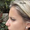 Minima differenza dopo aver fatto il Rinofiller