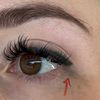 Rimozione tatuaggio eyeliner