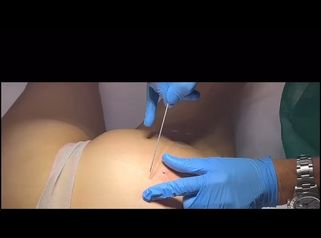 Dott.ssa Silvia Scevola Rimodellamento glutei