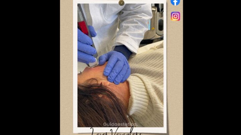 Laserterapia dei capillari del volto - Dott. Mario Marano