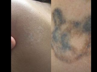 Rimozione tatuaggi - Dott. Giancarlo Delli Santi