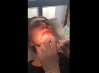Filler labbra